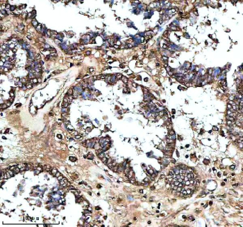 Immunohistochemical staining of MS4A4E using anti-MS4A4E antibody. MS4A4E was detected in a paraffin-embedded section of human ovarian cancer tissue. Heat mediated antigen retrieval was performed in EDTA buffer (pH 8.0, epitope retrieval solution). The tissue section was blocked with 10% goat serum. The tissue section was then incubated with 2 ug/ml rabbit anti-MS4A4E antibody overnight at 4oC. Peroxidase Conjugated Goat Anti-rabbit IgG was used as secondary antibody and incubated for 30 minutes at 37oC. The tissue section was developed using an HRP secondary and DAB substrate.