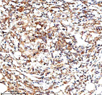 Immunohistochemical staining of IVNS1ABP using anti-IVNS1ABP antibody. IVNS1ABP was detected in a paraffin-embedded section of human ovarian cancer tissue. Heat mediated antigen retrieval was performed in EDTA buffer (pH 8.0, epitope retrieval solution). The tissue section was blocked with 10% goat serum. The tissue section was then incubated with 2 ug/ml rabbit anti-IVNS1ABP antibody overnight at 4oC. Peroxidase Conjugated Goat Anti-rabbit IgG was used as secondary antibody and incubated for 30 minutes at 37oC. The tissue section was developed using an HRP secondary and DAB substrate.