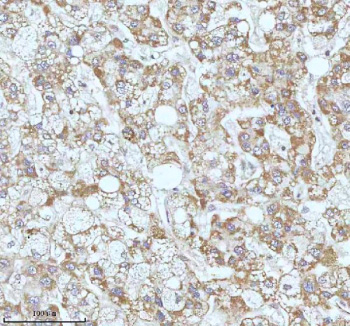 Immunohistochemical staining of GAREM1 using anti-GAREM1 antibody. GAREM1 was detected in a paraffin-embedded section of human liver cancer tissue. Heat mediated antigen retrieval was performed in EDTA buffer (pH 8.0, epitope retrieval solution). The tissue section was blocked with 10% goat serum. The tissue section was then incubated with 2 ug/ml rabbit anti-GAREM1 antibody overnight at 4oC. Peroxidase Conjugated Goat Anti-rabbit IgG was used as secondary antibody and incubated for 30 minutes at 37oC. The tissue section was developed using an HRP secondary and DAB substrate.
