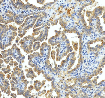 Immunohistochemical staining of xCT/SLC7A11 using anti-SLC7A11 antibody. xCT/SLC7A11 was detected in a paraffin-embedded section of human ovraian cancer tissue. Heat mediated antigen retrieval was performed in EDTA buffer (pH 8.0, epitope retrieval solution). The tissue section was blocked with 10% goat serum. The tissue section was then incubated with 2 ug/ml rabbit anti-SLC7A11 antibody overnight at 4oC. Peroxidase Conjugated Goat Anti-rabbit IgG was used as secondary antibody and incubated for 30 minutes at 37oC. The tissue section was developed using an HRP secondary and DAB substrate.