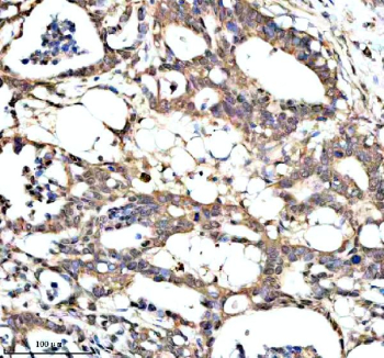 Immunohistochemical staining of PAN3 using anti-PAN3 antibody. PAN3 was detected in a paraffin-embedded section of human pancreas cancer tissue. Heat mediated antigen retrieval was performed in EDTA buffer (pH 8.0, epitope retrieval solution). The tissue section was blocked with 10% goat serum. The tissue section was then incubated with 2 ug/ml rabbit anti-PAN3 antibody overnight at 4oC. Peroxidase Conjugated Goat Anti-rabbit IgG was used as secondary antibody and incubated for 30 minutes at 37oC. The tissue section was developed using an HRP secondary and DAB substrate.