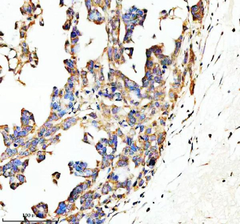 Immunohistochemical staining of SPON1 using anti-SPON1 antibody. SPON1 was detected in a paraffin-embedded section of human ovarian cancer tissue. Heat mediated antigen retrieval was performed in EDTA buffer (pH 8.0, epitope retrieval solution). The tissue section was blocked with 10% goat serum. The tissue section was then incubated with 2 ug/ml rabbit anti-SPON1 antibody overnight at 4oC. Peroxidase Conjugated Goat Anti-rabbit IgG was used as secondary antibody and incubated for 30 minutes at 37oC. The tissue section was developed using an HRP secondary and DAB substrate.