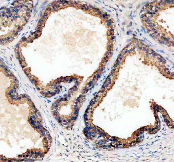 Immunohistochemical staining of TPD52 using anti-TPD52 antibody. TPD52 was detected in a paraffin-embedded section of human prostate cancer tissue. Heat mediated antigen retrieval was performed in EDTA buffer (pH 8.0, epitope retrieval solution). The tissue section was blocked with 10% goat serum. The tissue section was then incubated with 2 ug/ml rabbit anti-TPD52 antibody overnight at 4oC. Peroxidase Conjugated Goat Anti-rabbit IgG was used as secondary antibody and incubated for 30 minutes at 37oC. The tissue section was developed using an HRP secondary and DAB substrate.