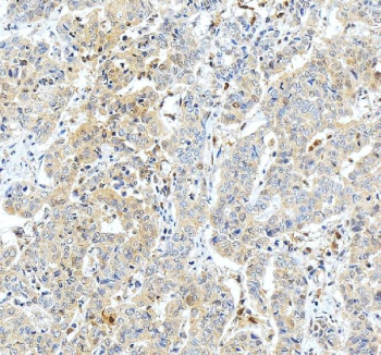 Immunohistochemical staining of GSTO1 using anti-GSTO1 antibody. GSTO1 was detected in a paraffin-embedded section of human liver cancer tissue. Heat mediated antigen retrieval was performed in EDTA buffer (pH 8.0, epitope retrieval solution). The tissue section was blocked with 10% goat serum. The tissue section was then incubated with 2 ug/ml rabbit anti-GSTO1 antibody overnight at 4oC. Peroxidase Conjugated Goat Anti-rabbit IgG was used as secondary antibody and incubated for 30 minutes at 37oC. The tissue section was developed using an HRP secondary and DAB substrate.