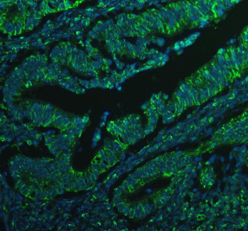 Immunofluorescent staining of BCAP31 using anti-BCAP31 antibody (green). BCAP31 was detected in a paraffin-embedded section of human colon cancer tissue. Heat mediated antigen retrieval was performed in EDTA buffer (pH 8.0, epitope retrieval solution). The tissue section was blocked with 10% goat serum. The tissue section was then incubated with 5 ug/ml rabbit anti-BCAP31 antibody overnight at 4oC. DyLight 488 Conjugated Goat Anti-Rabbit IgG was used as secondary antibody at 1:500 dilution and incubated for 30 minutes at 37oC. The section was counterstained with DAPI nuclear stain (blue). Visualize using a fluorescence microscope and filter sets appropriate for the label used.