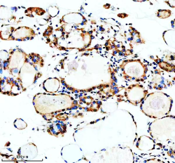 Immunohistochemical staining of MSI2 using anti-MSI2 antibody. MSI2 was detected in a paraffin-embedded section of human thyroid cancer tissue. Heat mediated antigen retrieval was performed in EDTA buffer (pH 8.0, epitope retrieval solution). The tissue section was blocked with 10% goat serum. The tissue section was then incubated with 2 ug/ml rabbit anti-MSI2 antibody overnight at 4oC. Peroxidase Conjugated Goat Anti-rabbit IgG was used as secondary antibody and incubated for 30 minutes at 37oC. The tissue section was developed using an HRP secondary and DAB substrate.