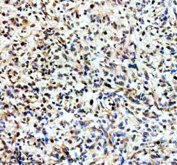 Immunohistochemical staining of TERF2IP using anti-TERF2IP antibody. TERF2IP was detected in a paraffin-embedded section of human glioma tissue. Heat mediated antigen retrieval was performed in EDTA buffer (pH 8.0, epitope retrieval solution). The tissue section was blocked with 10% goat serum. The tissue section was then incubated with 2 ug/ml rabbit anti-TERF2IP antibody overnight at 4oC. Peroxidase Conjugated Goat Anti-rabbit IgG was used as secondary antibody and incubated for 30 minutes at 37oC. The tissue section was developed using an HRP secondary and DAB substrate.