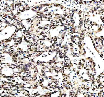 Immunohistochemical staining of RTRAF using anti-RTRAF antibody. RTRAF was detected in a paraffin-embedded section of human ovarian cancer tissue. Heat mediated antigen retrieval was performed in EDTA buffer (pH 8.0, epitope retrieval solution). The tissue section was blocked with 10% goat serum. The tissue section was then incubated with 2 ug/ml rabbit anti-RTRAF antibody overnight at 4oC. Peroxidase Conjugated Goat Anti-rabbit IgG was used as secondary antibody and incubated for 30 minutes at 37oC. The tissue section was developed using an HRP secondary and DAB substrate.
