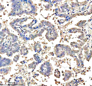 Immunohistochemical staining of ASCL1 using anti-ASCL1 antibody. ASCL1 was detected in a paraffin-embedded section of human lung cancer tissue. Heat mediated antigen retrieval was performed in EDTA buffer (pH 8.0, epitope retrieval solution). The tissue section was blocked with 10% goat serum. The tissue section was then incubated with 2 ug/ml rabbit anti-ASCL1 antibody overnight at 4oC. Peroxidase Conjugated Goat Anti-rabbit IgG was used as secondary antibody and incubated for 30 minutes at 37oC. The tissue section was developed using an HRP secondary and DAB substrate.