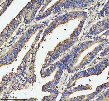 Immunohistochemical staining of SOS1 using anti-SOS1 antibody. SOS1 was detected in a paraffin-embedded section of human colon cancer tissue. Heat mediated antigen retrieval was performed in EDTA buffer (pH 8.0, epitope retrieval solution). The tissue section was blocked with 10% goat serum. The tissue section was then incubated with 2 ug/ml rabbit anti-SOS1 antibody overnight at 4oC. Peroxidase Conjugated Goat Anti-rabbit IgG was used as secondary antibody and incubated for 30 minutes at 37oC. The tissue section was developed using an HRP secondary and DAB substrate.