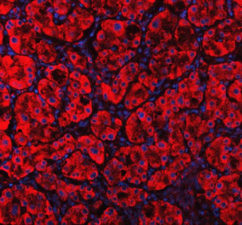 Immunofluorescent staining of MVK using anti-MVK antibody (red). MVK was detected in a paraffin-embedded section of human liver cancer tissue. Heat mediated antigen retrieval was performed in EDTA buffer (pH 8.0, epitope retrieval solution). The tissue section was blocked with 10% goat serum. The tissue section was then incubated with 5 ug/ml rabbit anti-MVK antibody overnight at 4oC. Cy3 Conjugated Goat Anti-Rabbit IgG was used as secondary antibody at 1:500 dilution and incubated for 30 minutes at 37oC. The section was counterstained with DAPI nuclear stain (blue). Visualize using a fluorescence microscope and filter sets appropriate for the label used.