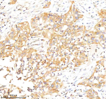 Immunohistochemical staining of RAB27B using anti-RAB27B antibody. RAB27B was detected in a paraffin-embedded section of human bladder cancer tissue. Heat mediated antigen retrieval was performed in EDTA buffer (pH 8.0, epitope retrieval solution). The tissue section was blocked with 10% goat serum. The tissue section was then incubated with 2 ug/ml rabbit anti-RAB27B antibody overnight at 4oC. Peroxidase Conjugated Goat Anti-rabbit IgG was used as secondary antibody and incubated for 30 minutes at 37oC. The tissue section was developed using an HRP secondary and DAB substrate.