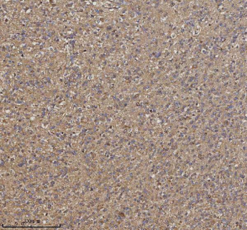 Immunohistochemical staining of TRIM2 using anti-TRIM2 antibody. TRIM2 was detected in a paraffin-embedded section of human glioblastoma tissue. Heat mediated antigen retrieval was performed in EDTA buffer (pH 8.0, epitope retrieval solution). The tissue section was blocked with 10% goat serum. The tissue section was then incubated with 2 ug/ml rabbit anti-TRIM2 antibody overnight at 4oC. Peroxidase Conjugated Goat Anti-rabbit IgG was used as secondary antibody and incubated for 30 minutes at 37oC. The tissue section was developed using an HRP secondary and DAB substrate.