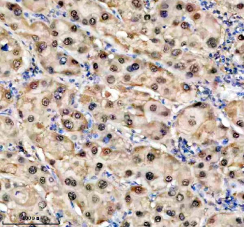 Immunohistochemical staining of TKFC using anti-TKFC antibody. TKFC was detected in a paraffin-embedded section of human liver cancer tissue. Heat mediated antigen retrieval was performed in EDTA buffer (pH 8.0, epitope retrieval solution). The tissue section was blocked with 10% goat serum. The tissue section was then incubated with 2 ug/ml rabbit anti-TKFC antibody overnight at 4oC. Peroxidase Conjugated Goat Anti-rabbit IgG was used as secondary antibody and incubated for 30 minutes at 37oC. The tissue section was developed using an HRP secondary and DAB substrate.