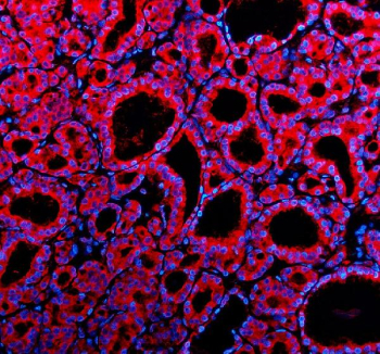 Immunofluorescent staining of Teneurin 1/TENM1 using anti-TENM1 antibody (red). Teneurin 1/TENM1 was detected in a paraffin-embedded section of human thyroid cancer tissue. Heat mediated antigen retrieval was performed in EDTA buffer (pH 8.0, epitope retrieval solution). The tissue section was blocked with 10% goat serum. The tissue section was then incubated with 5 ug/ml rabbit anti-TENM1 antibody overnight at 4oC. Cy3 Conjugated Goat Anti-Rabbit IgG was used as secondary antibody at 1:500 dilution and incubated for 30 minutes at 37oC. The section was counterstained with DAPI nuclear stain (blue). Visualize using a fluorescence microscope and filter sets appropriate for the label used.