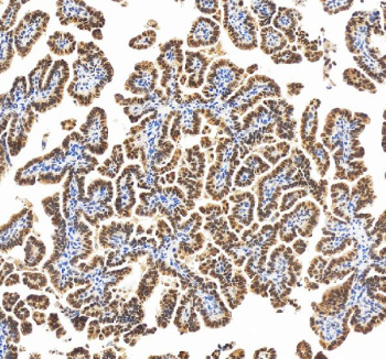 Immunohistochemical staining of RBM17 using anti-RBM17 antibody. RBM17 was detected in a paraffin-embedded section of human ovarian cancer tissue. Heat mediated antigen retrieval was performed in EDTA buffer (pH 8.0, epitope retrieval solution). The tissue section was blocked with 10% goat serum. The tissue section was then incubated with 2 ug/ml rabbit anti-RBM17 antibody overnight at 4oC. Peroxidase Conjugated Goat Anti-rabbit IgG was used as secondary antibody and incubated for 30 minutes at 37oC. The tissue section was developed using an HRP secondary and DAB substrate.