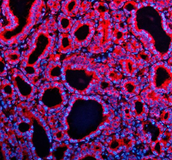 Immunofluorescent staining of TENM2 using anti-TENM2 antibody (red). TENM2 was detected in a paraffin-embedded section of human thyroid cancer tissue. Heat mediated antigen retrieval was performed in EDTA buffer (pH 8.0, epitope retrieval solution). The tissue section was blocked with 10% goat serum. The tissue section was then incubated with 5 ug/ml rabbit anti-TENM2 antibody overnight at 4oC. Cy3 Conjugated Goat Anti-Rabbit IgG was used as secondary antibody at 1:500 dilution and incubated for 30 minutes at 37oC. The section was counterstained with DAPI nuclear stain (blue). Visualize using a fluorescence microscope and filter sets appropriate for the label used.