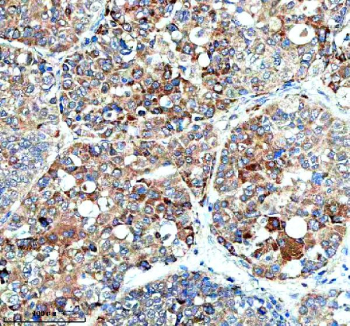 Immunohistochemical staining of HERC4 using anti-HERC4 antibody. HERC4 was detected in a paraffin-embedded section of human liver cancer tissue. Heat mediated antigen retrieval was performed in EDTA buffer (pH 8.0, epitope retrieval solution). The tissue section was blocked with 10% goat serum. The tissue section was then incubated with 2 ug/ml rabbit anti-HERC4 antibody overnight at 4oC. Peroxidase Conjugated Goat Anti-rabbit IgG was used as secondary antibody and incubated for 30 minutes at 37oC. The tissue section was developed using an HRP secondary and DAB substrate.