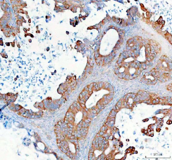 Immunohistochemical staining of SYNJ2 using anti-SYNJ2 antibody. SYNJ2 was detected in a paraffin-embedded section of human ovarian cancer tissue. Heat mediated antigen retrieval was performed in EDTA buffer (pH 8.0, epitope retrieval solution). The tissue section was blocked with 10% goat serum. The tissue section was then incubated with 2 ug/ml rabbit anti-SYNJ2 antibody overnight at 4oC. Peroxidase Conjugated Goat Anti-rabbit IgG was used as secondary antibody and incubated for 30 minutes at 37oC. The tissue section was developed using an HRP secondary and DAB substrate.