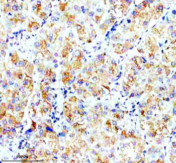 Immunohistochemical staining of OPN5 using anti-OPN5 antibody. OPN5 was detected in a paraffin-embedded section of human liver cancer tissue. Heat mediated antigen retrieval was performed in EDTA buffer (pH 8.0, epitope retrieval solution). The tissue section was blocked with 10% goat serum. The tissue section was then incubated with 2 ug/ml rabbit anti-OPN5 antibody overnight at 4oC. Peroxidase Conjugated Goat Anti-rabbit IgG was used as secondary antibody and incubated for 30 minutes at 37oC. The tissue section was developed using an HRP secondary and DAB substrate.