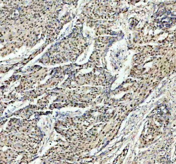 Immunohistochemical staining of PSME3 using anti-PSME3 antibody. PSME3 was detected in a paraffin-embedded section of human cervical cancer tissue. Heat mediated antigen retrieval was performed in EDTA buffer (pH 8.0, epitope retrieval solution). The tissue section was blocked with 10% goat serum. The tissue section was then incubated with 2 ug/ml rabbit anti-PSME3 antibody overnight at 4oC. Peroxidase Conjugated Goat Anti-rabbit IgG was used as secondary antibody and incubated for 30 minutes at 37oC. The tissue section was developed using an HRP secondary and DAB substrate.