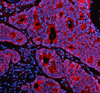 Immunofluorescent staining of PEX1 using anti-PEX1 antibody (red). PEX1 was detected in a paraffin-embedded section of human colon cancer tissue. Heat mediated antigen retrieval was performed in EDTA buffer (pH 8.0, epitope retrieval solution). The tissue section was blocked with 10% goat serum. The tissue section was then incubated with 5 ug/ml rabbit anti-PEX1 antibody overnight at 4oC. Cy3 Conjugated Goat Anti-Rabbit IgG was used as secondary antibody at 1:500 dilution and incubated for 30 minutes at 37oC. The section was counterstained with DAPI nuclear stain (blue). Visualize using a fluorescence microscope and filter sets appropriate for the label used.