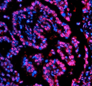 Immunofluorescent staining of NUPR1 using anti-NUPR1 antibody (red). NUPR1 was detected in a paraffin-embedded section of human lung cancer tissue. Heat mediated antigen retrieval was performed in EDTA buffer (pH 8.0, epitope retrieval solution). The tissue section was blocked with 10% goat serum. The tissue section was then incubated with 5 ug/ml rabbit anti-NUPR1 antibody overnight at 4oC. Cy3 Conjugated Goat Anti-Rabbit IgG was used as secondary antibody at 1:500 dilution and incubated for 30 minutes at 37oC. The section was counterstained with DAPI nuclear stain (blue). Visualize using a fluorescence microscope and filter sets appropriate for the label used.