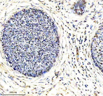 Immunohistochemical staining of using anti-ARL2 antibody. was detected in a paraffin-embedded section of human cervical cancer tissue. Heat mediated antigen retrieval was performed in EDTA buffer (pH 8.0, epitope retrieval solution). The tissue section was blocked with 10% goat serum. The tissue section was then incubated with 2 ug/ml rabbit anti-ARL2 antibody overnight at 4oC. Peroxidase Conjugated Goat Anti-rabbit IgG was used as secondary antibody and incubated for 30 minutes at 37oC. The tissue section was developed using an HRP secondary and DAB substrate.