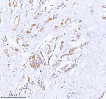 Immunohistochemical staining of PCYOX1 using anti-PCYOX1 antibody. PCYOX1 was detected in a paraffin-embedded section of human breast cancer tissue. Heat mediated antigen retrieval was performed in EDTA buffer (pH 8.0, epitope retrieval solution). The tissue section was blocked with 10% goat serum. The tissue section was then incubated with 2 ug/ml rabbit anti-PCYOX1 antibody overnight at 4oC. Peroxidase Conjugated Goat Anti-rabbit IgG was used as secondary antibody and incubated for 30 minutes at 37oC. The tissue section was developed using an HRP secondary and DAB substrate.