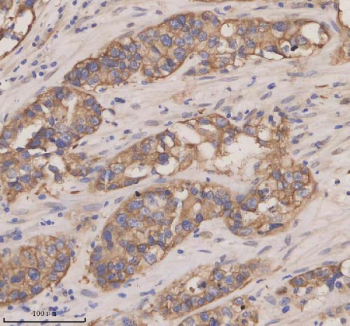 Immunohistochemical staining of CXCL13 using anti-CXCL13 antibody. CXCL13 was detected in a paraffin-embedded section of human appendiceal adenocarcinoma tissue. Heat mediated antigen retrieval was performed in EDTA buffer (pH 8.0, epitope retrieval solution). The tissue section was blocked with 10% goat serum. The tissue section was then incubated with 2 ug/ml rabbit anti-CXCL13 antibody overnight at 4oC. Peroxidase Conjugated Goat Anti-rabbit IgG was used as secondary antibody and incubated for 30 minutes at 37oC. The tissue section was developed using an HRP secondary and DAB substrate.