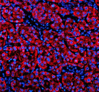 Immunofluorescent staining of SHD using anti-SHD antibody (red). SHD was detected in a paraffin-embedded section of human liver cancer tissue. Heat mediated antigen retrieval was performed in EDTA buffer (pH 8.0, epitope retrieval solution). The tissue section was blocked with 10% goat serum. The tissue section was then incubated with 5 ug/ml rabbit anti-SHD antibody overnight at 4oC. Cy3 Conjugated Goat Anti-Rabbit IgG was used as secondary antibody at 1:500 dilution and incubated for 30 minutes at 37oC. The section was counterstained with DAPI nuclear stain (blue). Visualize using a fluorescence microscope and filter sets appropriate for the label used.