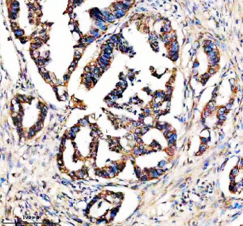 Immunohistochemical staining of STX4 using anti-STX4 antibody. STX4 was detected in a paraffin-embedded section of human colon cancer tissue. Heat mediated antigen retrieval was performed in EDTA buffer (pH 8.0, epitope retrieval solution). The tissue section was blocked with 10% goat serum. The tissue section was then incubated with 2 ug/ml rabbit anti-STX4 antibody overnight at 4oC. Peroxidase Conjugated Goat Anti-rabbit IgG was used as secondary antibody and incubated for 30 minutes at 37oC. The tissue section was developed using an HRP secondary and DAB substrate.