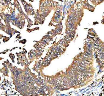 Immunohistochemical staining of QRSL1 using anti-QRSL1 antibody. QRSL1 was detected in a paraffin-embedded section of human colon cancer tissue. Heat mediated antigen retrieval was performed in EDTA buffer (pH 8.0, epitope retrieval solution). The tissue section was blocked with 10% goat serum. The tissue section was then incubated with 2 ug/ml rabbit anti-QRSL1 antibody overnight at 4oC. Peroxidase Conjugated Goat Anti-rabbit IgG was used as secondary antibody and incubated for 30 minutes at 37oC. The tissue section was developed using an HRP secondary and DAB substrate.