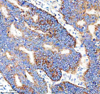 Immunohistochemical staining of IER3 using anti-IER3 antibody. IER3 was detected in a paraffin-embedded section of human stomach cancer tissue. Heat mediated antigen retrieval was performed in EDTA buffer (pH 8.0, epitope retrieval solution). The tissue section was blocked with 10% goat serum. The tissue section was then incubated with 2 ug/ml rabbit anti-IER3 antibody overnight at 4oC. Peroxidase Conjugated Goat Anti-rabbit IgG was used as secondary antibody and incubated for 30 minutes at 37oC. The tissue section was developed using an HRP secondary and DAB substrate.