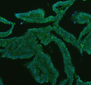 Immunofluorescent staining of GATM using anti-GATM antibody (green). GATM was detected in a paraffin-embedded section of human breast cancer tissue. Heat mediated antigen retrieval was performed in EDTA buffer (pH 8.0, epitope retrieval solution). The tissue section was blocked with 10% goat serum. The tissue section was then incubated with 5 ug/ml rabbit anti-GATM antibody overnight at 4oC. DyLight 488 Conjugated Goat Anti-Rabbit IgG was used as secondary antibody at 1:500 dilution and incubated for 30 minutes at 37oC. The section was counterstained with DAPI nuclear stain (blue). Visualize using a fluorescence microscope and filter sets appropriate for the label used.