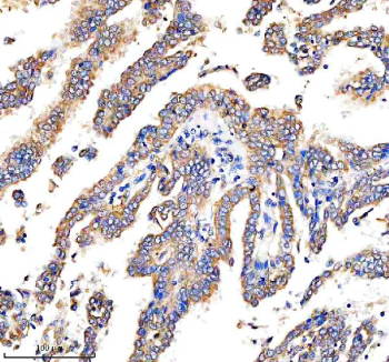 Immunohistochemical staining of DEPDC6/DEPTOR using anti-DEPTOR antibody. DEPDC6/DEPTOR was detected in a paraffin-embedded section of human lung cancer tissue. Heat mediated antigen retrieval was performed in EDTA buffer (pH 8.0, epitope retrieval solution). The tissue section was blocked with 10% goat serum. The tissue section was then incubated with 2 ug/ml rabbit anti-DEPTOR antibody overnight at 4oC. Peroxidase Conjugated Goat Anti-rabbit IgG was used as secondary antibody and incubated for 30 minutes at 37oC. The tissue section was developed using an HRP secondary and DAB substrate.