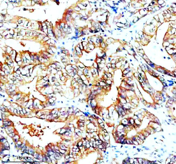 Immunohistochemical staining of SNX2 using anti-SNX2 antibody. SNX2 was detected in a paraffin-embedded section of human colon cancer tissue. Heat mediated antigen retrieval was performed in EDTA buffer (pH 8.0, epitope retrieval solution). The tissue section was blocked with 10% goat serum. The tissue section was then incubated with 2 ug/ml rabbit anti-SNX2 antibody overnight at 4oC. Peroxidase Conjugated Goat Anti-rabbit IgG was used as secondary antibody and incubated for 30 minutes at 37oC. The tissue section was developed using an HRP secondary and DAB substrate.