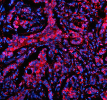 Immunofluorescent staining of MTMR3 using anti-MTMR3 antibody (red). MTMR3 was detected in a paraffin-embedded section of human breast cancer tissue. Heat mediated antigen retrieval was performed in EDTA buffer (pH 8.0, epitope retrieval solution). The tissue section was blocked with 10% goat serum. The tissue section was then incubated with 5 ug/ml rabbit anti-MTMR3 antibody overnight at 4oC. Cy3 Conjugated Goat Anti-Rabbit IgG was used as secondary antibody at 1:500 dilution and incubated for 30 minutes at 37oC. The section was counterstained with DAPI nuclear stain (blue). Visualize using a fluorescence microscope and filter sets appropriate for the label used.