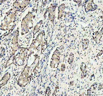 Immunohistochemical staining of RANBP3 using anti-RANBP3 antibody. RANBP3 was detected in a paraffin-embedded section of human breast cancer tissue. Heat mediated antigen retrieval was performed in EDTA buffer (pH 8.0, epitope retrieval solution). The tissue section was blocked with 10% goat serum. The tissue section was then incubated with 2 ug/ml rabbit anti-RANBP3 antibody overnight at 4oC. Peroxidase Conjugated Goat Anti-rabbit IgG was used as secondary antibody and incubated for 30 minutes at 37oC. The tissue section was developed using an HRP secondary and DAB substrate.
