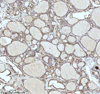 Immunohistochemical staining of IDH3B using anti-IDH3B antibody. IDH3B was detected in a paraffin-embedded section of follicles of human thyroid cancer tissue. Heat mediated antigen retrieval was performed in EDTA buffer (pH 8.0, epitope retrieval solution). The tissue section was blocked with 10% goat serum. The tissue section was then incubated with 2 ug/ml rabbit anti-IDH3B antibody overnight at 4oC. Peroxidase Conjugated Goat Anti-rabbit IgG was used as secondary antibody and incubated for 30 minutes at 37oC. The tissue section was developed using an HRP secondary and DAB substrate.