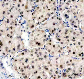 Immunohistochemical staining of TRIM47 using anti-TRIM47 antibody. TRIM47 was detected in a paraffin-embedded section of human liver cancer tissue. Heat mediated antigen retrieval was performed in EDTA buffer (pH 8.0, epitope retrieval solution). The tissue section was blocked with 10% goat serum. The tissue section was then incubated with 2 ug/ml rabbit anti-TRIM47 antibody overnight at 4oC. Peroxidase Conjugated Goat Anti-rabbit IgG was used as secondary antibody and incubated for 30 minutes at 37oC. The tissue section was developed using an HRP secondary and DAB substrate.