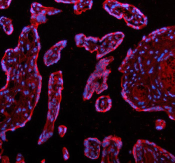 Immunofluorescent staining of ADAM12 using anti-ADAM12 antibody (red). ADAM12 was detected in a paraffin-embedded section of human placenta tissue. Heat mediated antigen retrieval was performed in EDTA buffer (pH 8.0, epitope retrieval solution). The tissue section was blocked with 10% goat serum. The tissue section was then incubated with 5 ug/ml rabbit anti-ADAM12 antibody overnight at 4oC. Cy3 Conjugated Goat Anti-Rabbit IgG was used as secondary antibody at 1:500 dilution and incubated for 30 minutes at 37oC. The section was counterstained with DAPI nuclear stain (blue). Visualize using a fluorescence microscope and filter sets appropriate for the label used.