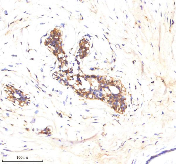 Immunohistochemical staining of ATP1A2 using anti-ATP1A2 antibody. ATP1A2 was detected in a paraffin-embedded section of human breast cancer tissue. Heat mediated antigen retrieval was performed in EDTA buffer (pH 8.0, epitope retrieval solution). The tissue section was blocked with 10% goat serum. The tissue section was then incubated with 2 ug/ml rabbit anti-ATP1A2 antibody overnight at 4oC. Peroxidase Conjugated Goat Anti-rabbit IgG was used as secondary antibody and incubated for 30 minutes at 37oC. The tissue section was developed using an HRP secondary and DAB substrate.
