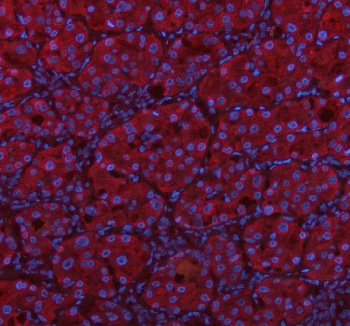 Immunofluorescent staining of MSTO1 using anti-MSTO1 antibody (red). MSTO1 was detected in a paraffin-embedded section of human liver cancer tissue. Heat mediated antigen retrieval was performed in EDTA buffer (pH 8.0, epitope retrieval solution). The tissue section was blocked with 10% goat serum. The tissue section was then incubated with 5 ug/ml rabbit anti-MSTO1 antibody overnight at 4oC. Cy3 Conjugated Goat Anti-Rabbit IgG was used as secondary antibody at 1:500 dilution and incubated for 30 minutes at 37oC. The section was counterstained with DAPI nuclear stain (blue). Visualize using a fluorescence microscope and filter sets appropriate for the label used.