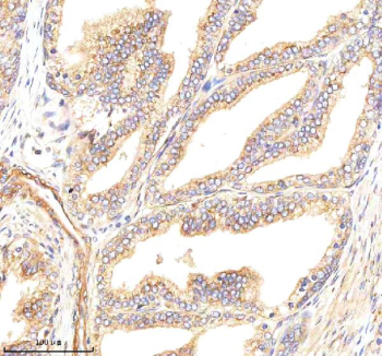 Immunohistochemical staining of GBF1 using anti-GBF1 antibody. GBF1 was detected in a paraffin-embedded section of human prostate cancer tissue. Heat mediated antigen retrieval was performed in EDTA buffer (pH 8.0, epitope retrieval solution). The tissue section was blocked with 10% goat serum. The tissue section was then incubated with 2 ug/ml rabbit anti-GBF1 antibody overnight at 4oC. Peroxidase Conjugated Goat Anti-rabbit IgG was used as secondary antibody and incubated for 30 minutes at 37oC. The tissue section was developed using an HRP secondary and DAB substrate.