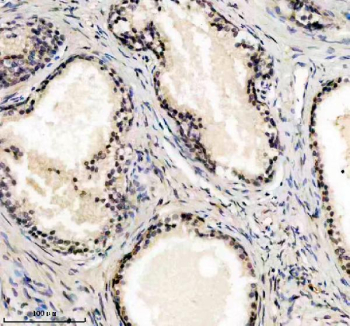 Immunohistochemical staining of UBE2F using anti-UBE2F antibody. UBE2F was detected in a paraffin-embedded section of human prostate cancer tissue. Heat mediated antigen retrieval was performed in EDTA buffer (pH 8.0, epitope retrieval solution). The tissue section was blocked with 10% goat serum. The tissue section was then incubated with 2 ug/ml rabbit anti-UBE2F antibody overnight at 4oC. Peroxidase Conjugated Goat Anti-rabbit IgG was used as secondary antibody and incubated for 30 minutes at 37oC. The tissue section was developed using an HRP secondary and DAB substrate.