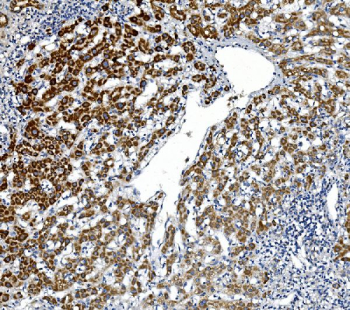 Immunohistochemical staining of GPNMB using anti-GPNMB antibody. GPNMB was detected in paraffin-embedded section of human liver cancer. Heat mediated antigen retrieval was performed in EDTA buffer (pH 8.0, epitope retrieval solution). The tissue section was blocked with 10% goat serum. The tissue section was then incubated with 1ug/ml rabbit anti-GPNMB antibody overnight at 4oC. Biotinylated goat anti-rabbit IgG was used as secondary antibody and incubated for 30 minutes at 37oC. The tissue section was developed using Strepavidin-Biotin-Complex (SABC) with DAB as the chromogen.