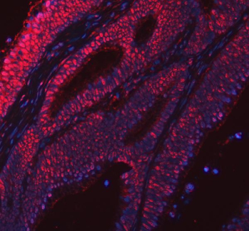Immunofluorescent staining of FFPE human colorectal cancer tissue with RSRC2 antibody (red) and DAPI nuclear stain (blue). HIER: steam section in pH8 EDTA buffer for 20 min.