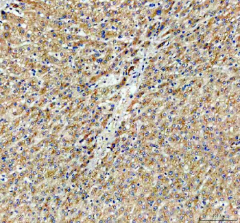 Immunohistochemical staining of CYP26B1 using anti-CYP26B1 antibody. CYP26B1 was detected in a paraffin-embedded section of human liver cancer tissue. Heat mediated antigen retrieval was performed in EDTA buffer (pH 8.0, epitope retrieval solution). The tissue section was blocked with 10% goat serum. The tissue section was then incubated with 2 ug/ml rabbit anti-CYP26B1 antibody overnight at 4oC. Peroxidase Conjugated Goat Anti-rabbit IgG was used as secondary antibody and incubated for 30 minutes at 37oC. The tissue section was developed using an HRP secondary and DAB substrate.