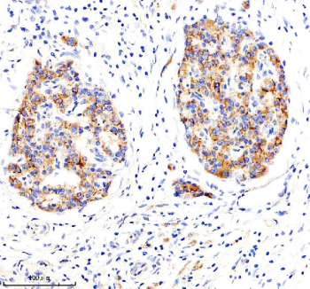 Immunohistochemical staining of LRG1 using anti-LRG1 antibody. LRG1 was detected in a paraffin-embedded section of human pancreas cancer tissue. Heat mediated antigen retrieval was performed in EDTA buffer (pH 8.0, epitope retrieval solution). The tissue section was blocked with 10% goat serum. The tissue section was then incubated with 1:100 rabbit anti-LRG1 antibody overnight at 4oC. Peroxidase Conjugated Goat Anti-rabbit IgG was used as secondary antibody and incubated for 30 minutes at 37oC. The tissue section was developed using an HRP secondary and DAB substrate.